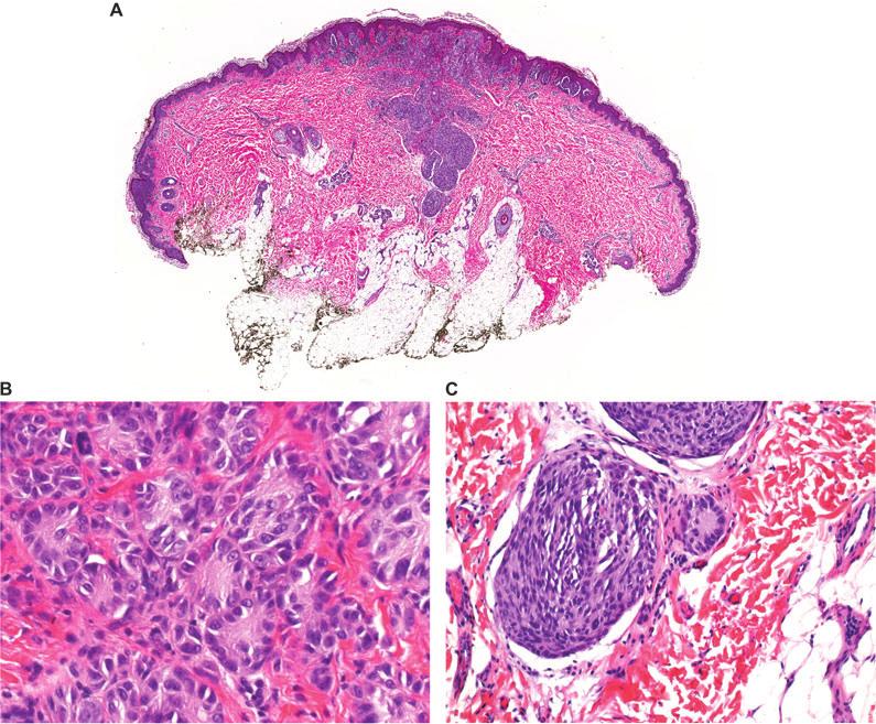 Arps et al. Fig. 1. Case 1. Compound Spitz nevus with rosette-like structures from the forearm of an 8-year-old female, H&E. A) Wedge-shaped, symmetric compound lesion, 10.