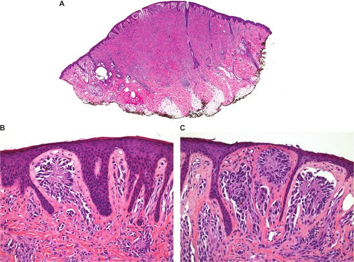 Arps et al. Fig. 3. Case 2. Intradermal desmoplastic Spitz nevus from the cheek of a 20-year-old male, H&E.