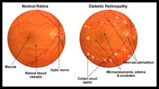 Normal Retina and Diabetic Retinopathy Symptoms Seeing spots or floaters in your field of vision