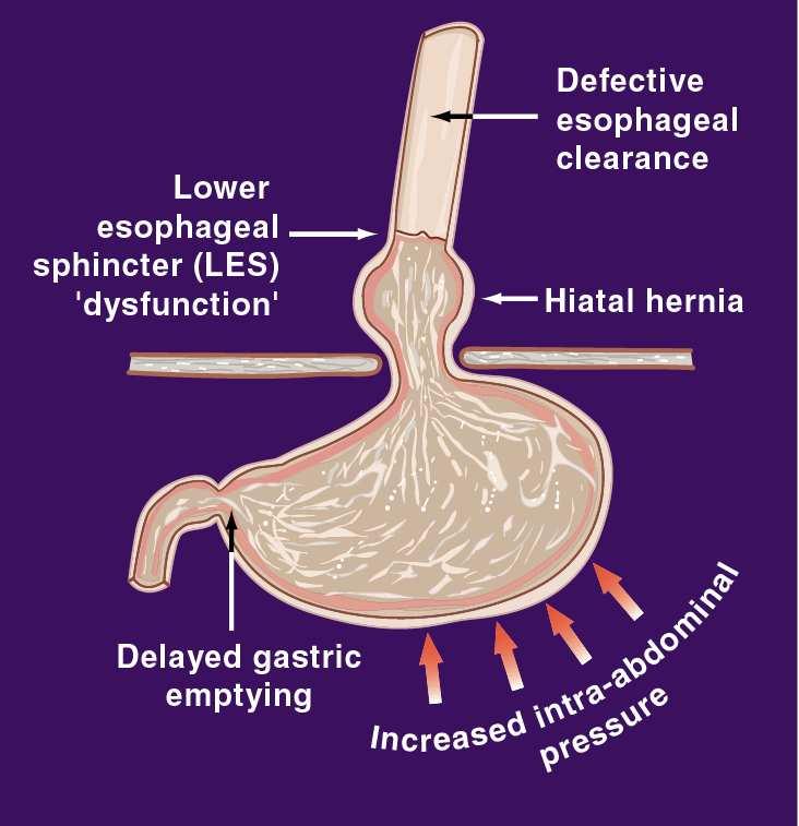 increase in the volume of gastric contents available for reflux into the esophagus Exact role in GERD remains to be clarified Causes of increased exposure of the esophagus to gastric