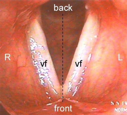 with effusion Sinusitis Serous otitis media Sinus Headache Upper airway itching Normal From www.voiceproblem.