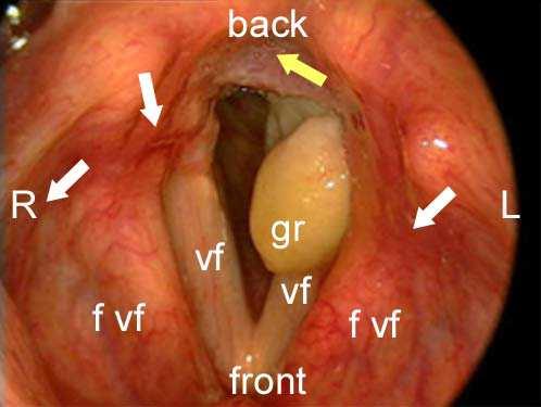 mucosa or indirectly, too, by reflex influences from the stomach. Up to 80% of patients with asthma have GERD.