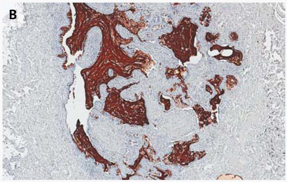 Immunohistochemical Staining of MUC5B in Lung Tissue from Subjects with Idiopathic Pulmonary Fibrosis and Controls.
