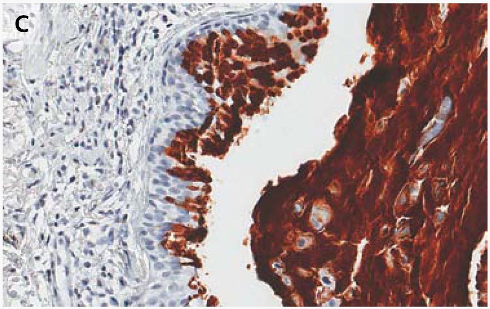 Immunohistochemical Staining of MUC5B in Lung Tissue from Subjects with Idiopathic Pulmonary Fibrosis and Controls.