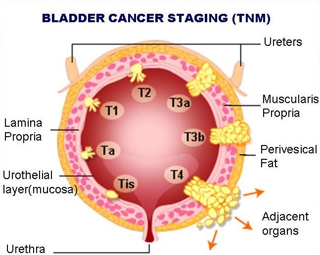 Pathology: Stage Tis=CIS Tis=CIS Ta: Non-invasive T1: Lamina propria invasion T2a: Muscle