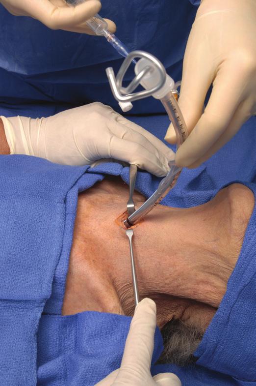 Section 2: Resuscitative Procedures in the ER With the dominant hand, insert the cricothyrotomy tube into the trachea. Having the obturator in place will aid in this process.
