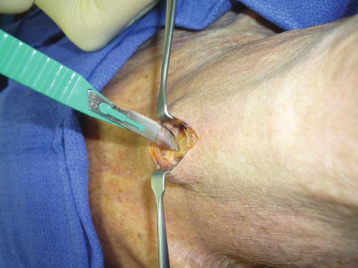 A transverse incision is an acceptable option, but a vertical incision is preferred because there is a decreased risk of bleeding from the anterior jugular veins and the incision is more versatile as