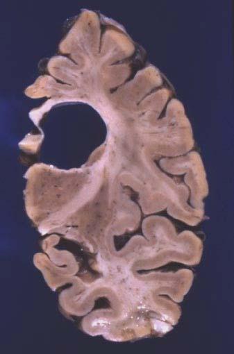 Corticobasal degeneration Atrophy of the