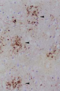 Hyper-phosphorylated tau is found in neurons