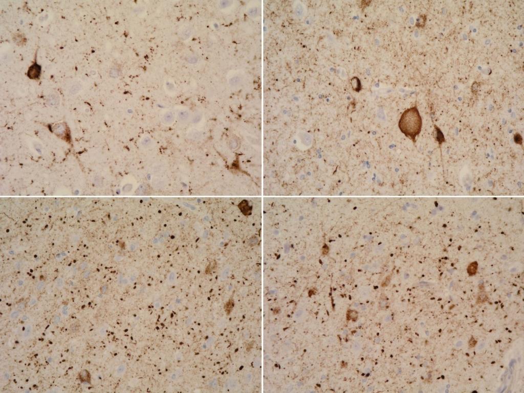 AGD A B C D Argyrophilic grains in CA1 (A), entorhinal cortex