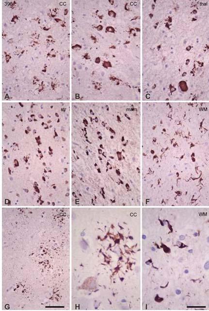 FTLD K317M Generalized neuronal and glial hyperphosphorylated tau deposits in the cerebral cortex (cc), thalamus (thal), striatum (str), mammillary bodies (mam) and
