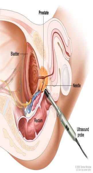 Diagnosis Prostate biopsy Transrectal TRUS or a transperineal laterally-directed core biopsy is the standard way to obtain material for histopathology 1 A 10 12 core systematic biopsy targeting the