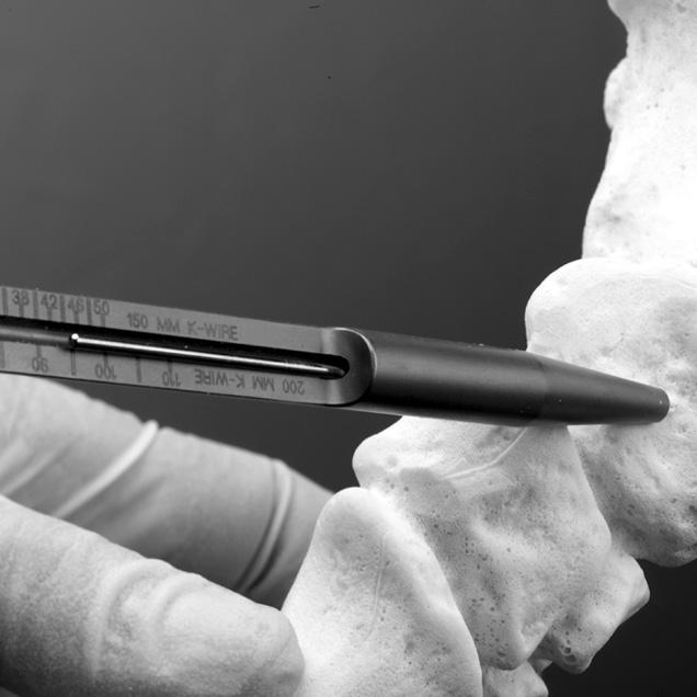 A powered drill can also be used to further penetrate the subchondral bone to ensure that bleeding bony surfaces are in apposition prior to screw insertion.