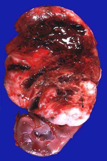 CLEAR CELL SARCOMA OF THE KIDNEY 4% of Renal Tumors Peak 2nd Yr of Life 1.6M:1.