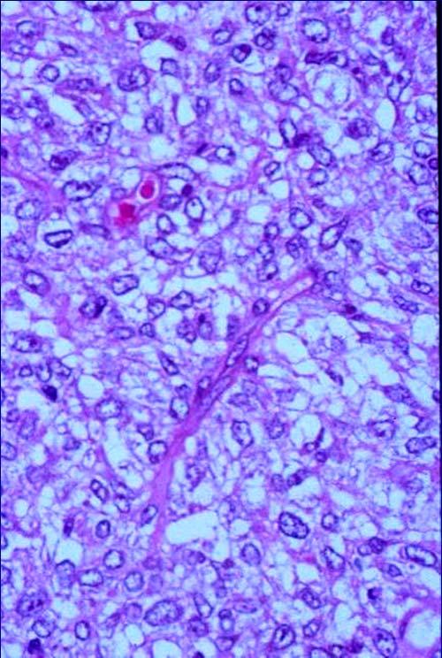 Kidney : Highly Aggressive Tumor CLEAR CELL SARCOMA Monomorphous Polygonal Clear to Eosinophilic Cells Variants: Epithelioid, Spindled,