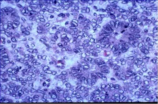 survival Clear Cell Sarcoma of Kidney CCSK six