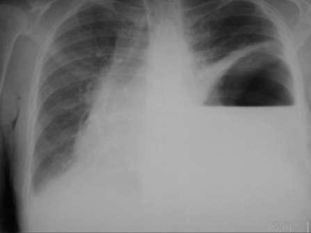 pyopneumothorax In pyopneumothorax a layer of gas is