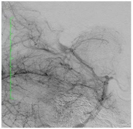 726 Figure 4b Figure 4a-4b: DSA performed four months after the embolization procedure, revealing complete occlusion of the nidus, which is not opacified.