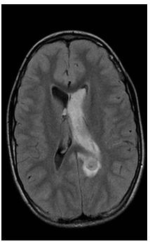 721 Figure 1j Figure 1a-1j: Initial MRI scan, T2 W, Τ2*GRE, T1W before and after gadolinium enhancement and FLAIR, revealing intra-parenchymal hemorrhage in the anatomic territory of the splenium of