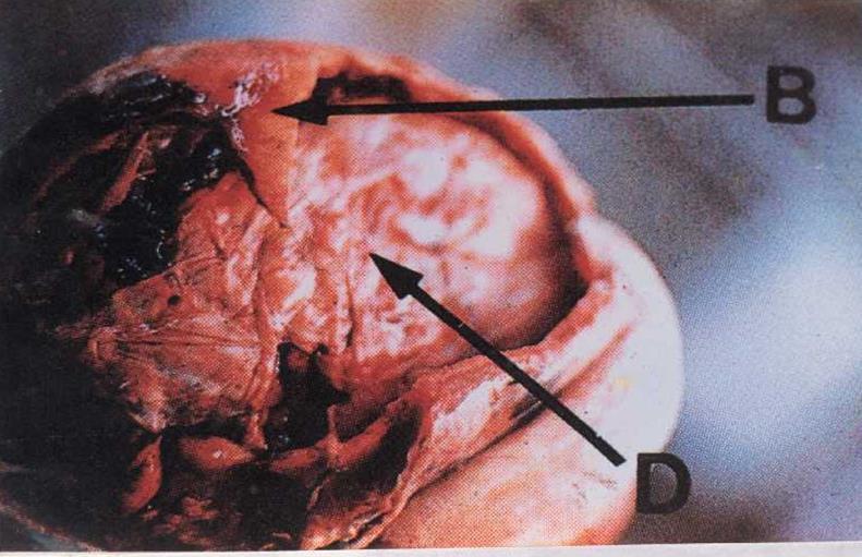A- Extradural hemorrhage - It is due to trauma by a blow on the side of the head leading to