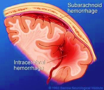 C- Subarachnoid hemorrhage - It occurs between arachnoid and pia mater.