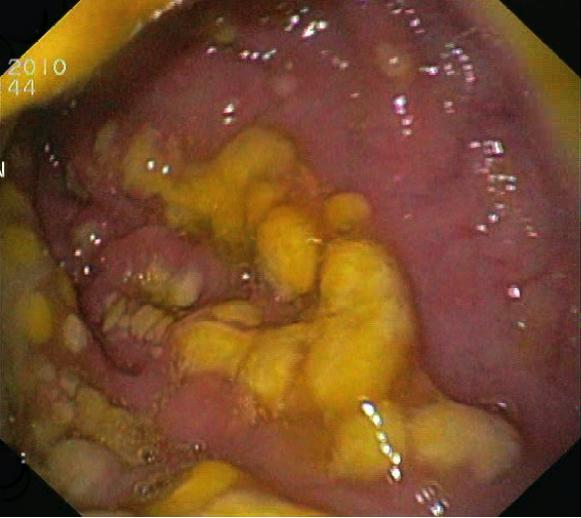 Clostrodium difficile commonly causes an inflammation of the colon called pseudomembranous colitis. This image shows yellow pseudomembranes on the wall of the colon.