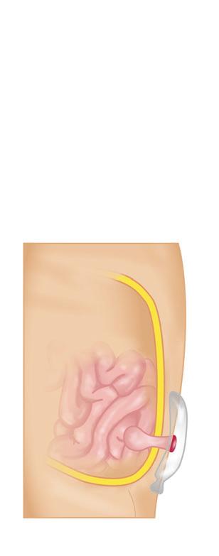 first step and normally takes 2-3 hours. The abdominal colon is removed, the rectum remains and the end of the small intestine is brought out as a stoma (see Picture 2).