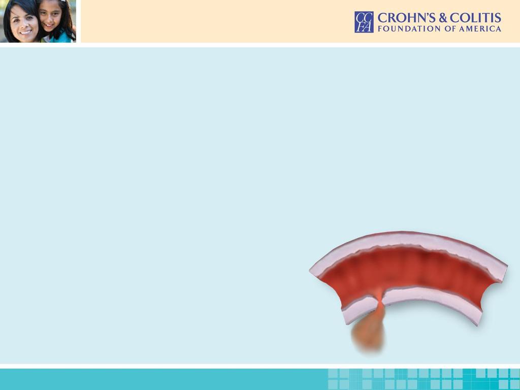 Understanding Complications of Ulcerative Colitis Anemia from blood loss