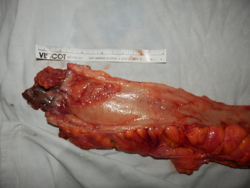 Cut section tumor at lower