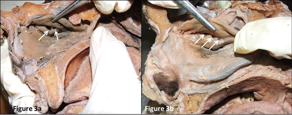 Figure 2: Variations in the middle meatus. Figure 2a: Bifid middle nasal concha. Figure 2b:Bifid middle nasal concha with hypertrophied bulla. Figure 2c:Split middle nasal concha.