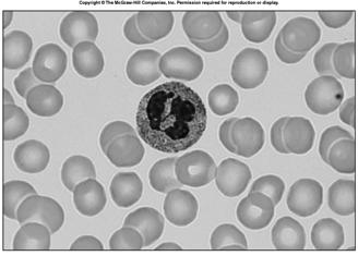 Polycythemia having to many red blood cells 10 White Blood Cells leukocytes protect against disease interleukins and colony-stimulating factors stimulate development granulocytes neutrophils