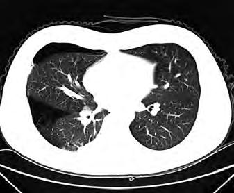 3.2 Discussion A Figure 4. (A) CT image of pneumothorax with cluster of lung cysts in the right lower lobe(4a).