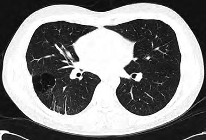 We report here two pediatric patients with recurrent spontaneous pneumothorax, as part of the Birt-Hogg-Dubé (BHD) syndrome.
