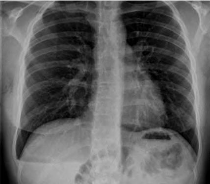Dames en Heren, Een pneumothorax (klaplong) ontstaat als er lucht komt tussen de pariëtale en viscerale pleura. De long kan zich hierdoor niet meer volledig ontplooien.