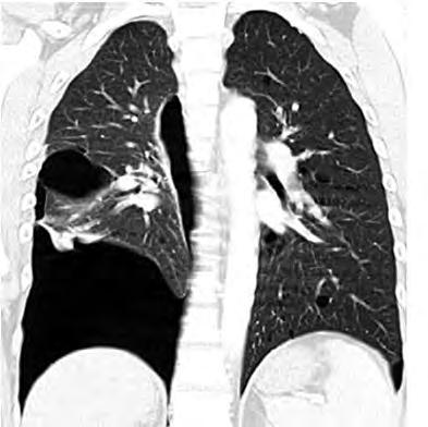 Naar oorzaak wordt pneumothorax ingedeeld in 1) spontane pneumothorax, a) primair, zonder bekende oorzaak of b) secundair, als gevolg van een al bestaande longaandoening, 2) traumatische en 3)