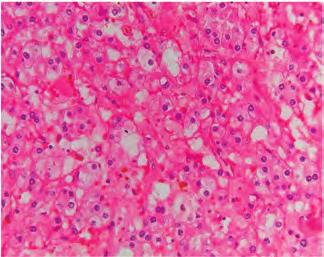 Figuur 3. Histologisch beeld van het heldercellige niercarcinoom, opgetreden bij patiënt D. 3.4 SP as indicator for rcc Figuur 4. Stamboom van de beschreven familie.