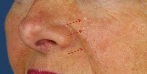 3.5 Fibrofolliculomas as indicator for BHD syndrome A 53-year old woman was referred to our hospital because of an increasing number of facial skin papules on her cheeks and ears.