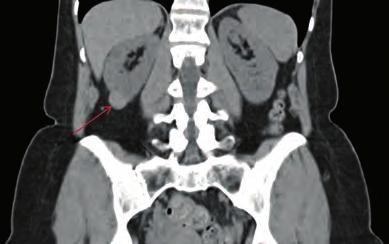 contrast, which showed a solid interpolar tumour in the lower pole of the right kidney, with a diameter of 19 mm, classified as T1N0Mx (figure 2).