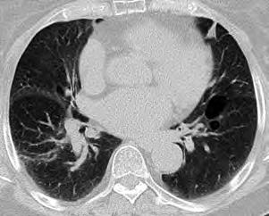 Figure 3. Thoracic CT: Multiple lung cysts in the basel parts of both lungs. Sequencing of the FLCN gene showed a pathogenic splice site mutation in exon 12 (c.