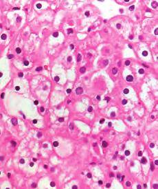 5) and detail (B: amplification X40) of monotonous cellular pattern with mild nuclear pleomorphy and abundant partly eosinophilic cytoplasm with perinuclear halo, compatible with chromophobe renal