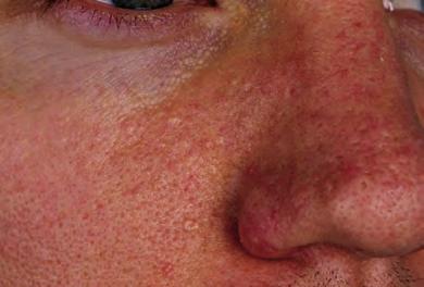 Figure 1. Multiple smooth facial papules in the proband. 3.