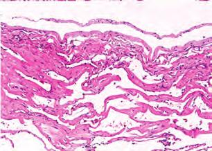 alveolar spaces and local marginal fibrotic thickening of