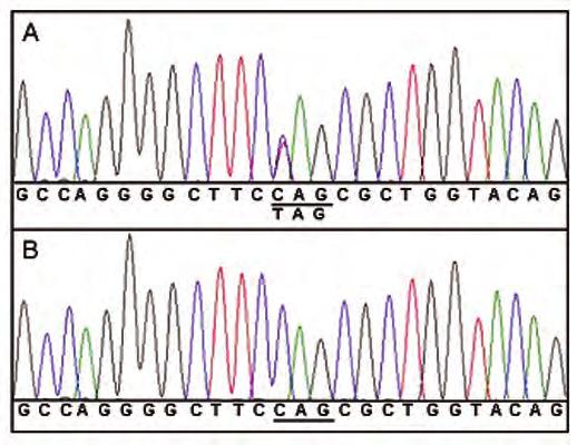Figure 6. Electropherogram of part of exon 6 of FLCN. (A) sequence of the DNA of the patient showing the FLCN mutation c.