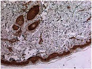 A B C D 3.7 de novo FLCN mutation in patient with SP and RCC Figure 8. Immunohistochemical staining of the renal tumor with a polyclonal FLCN antibody. (A) Unaffected kidney tissue of the proband.