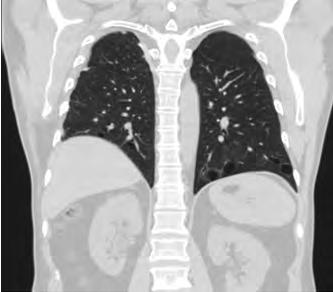 0.1 A Figure 6. Thoracic CT scan: lung cysts in basal parts of the lung in BHD patient (Adapted from Johannesma et al.