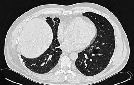 A B 1.6 Figure 2. High resolution computed tomography of the chest of a non-tested PSP patient, clinically suspected for Birt- Hogg-Dubé syndrome.