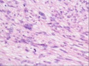 Figure 4: Tumor cell necrosis.