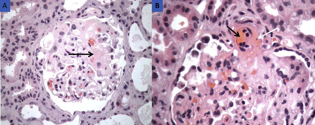 HUS: Mesangiolysis, fibrin thrombi and fibrinoid necrosis involving the glomerular vascular pole Arteriolar & capillary microthrombi