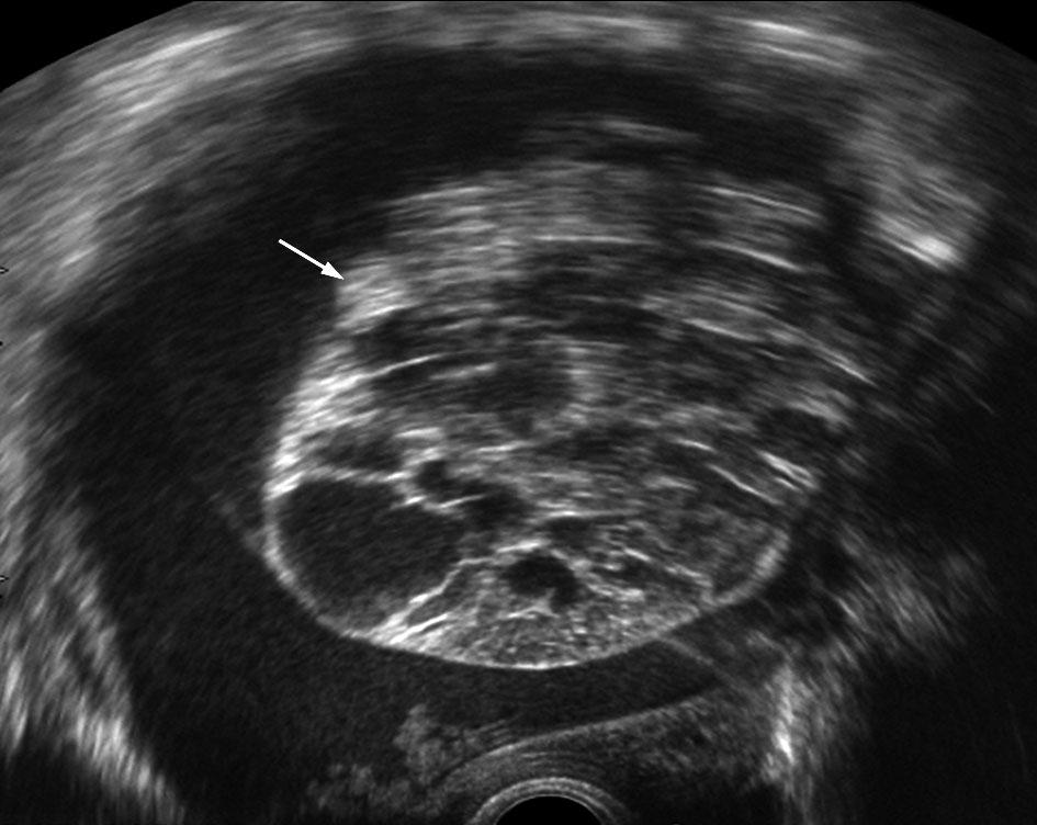 Diagnosis of borderline ovarian tumors 491 RESULTS Figure 3 Ultrasound image showing a mucinous gastrointestinal-type borderline ovarian tumor.