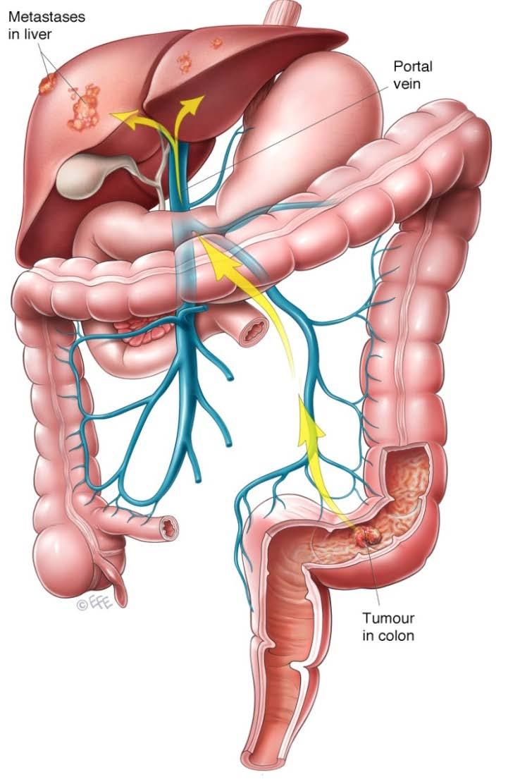 2. Colorectal cancer Colorectal cancer that has metastasized (mcrc) is usually difficult to
